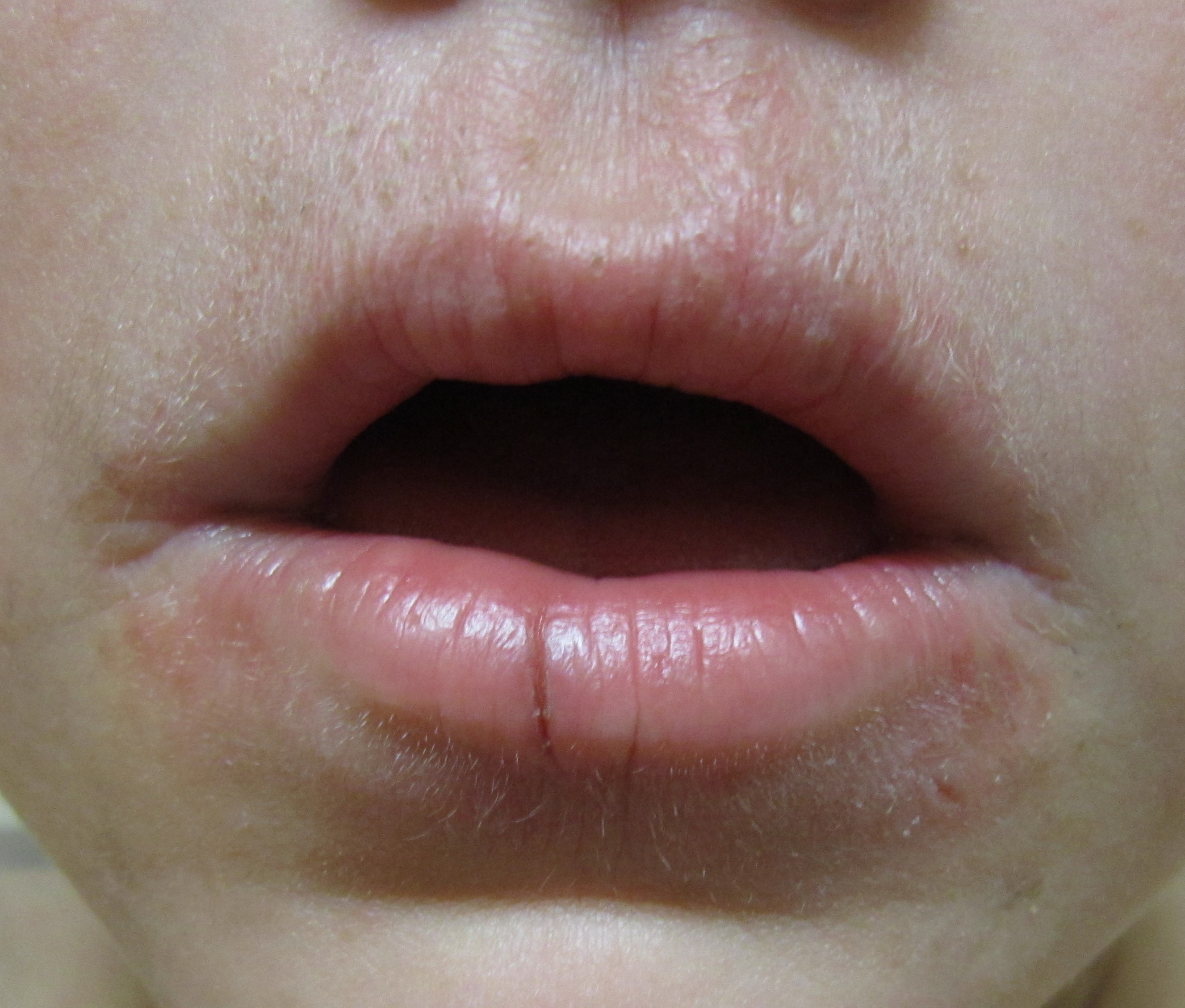 Simple Natural Treatment of Dry Lips By Home Remedies