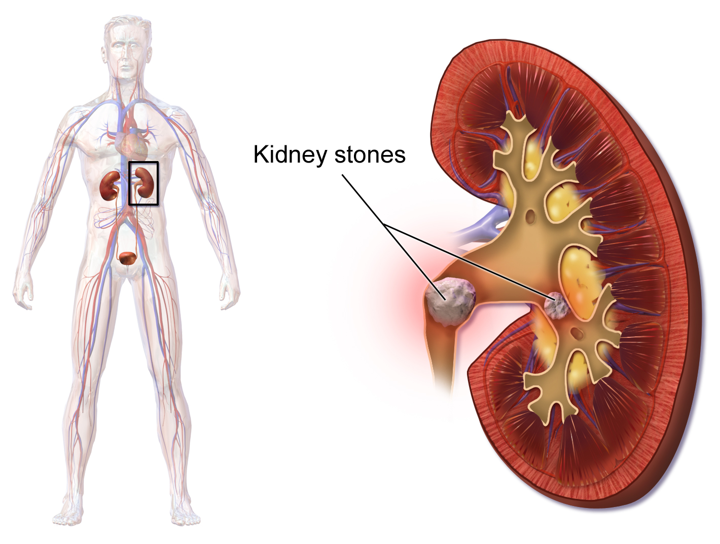 kidney stone diet