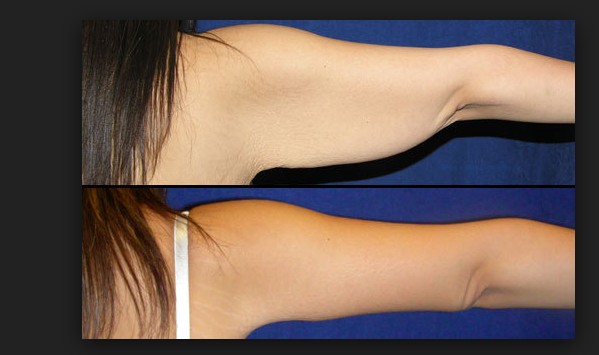 How to reduce arm fat