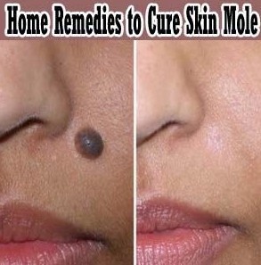 home remdies to cure moles