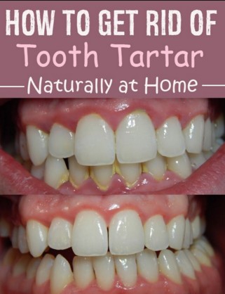 remove plaque and tartar