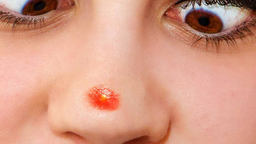 How To Get Rid Of Pimple On Nose