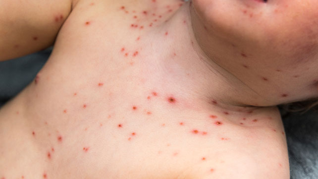 Tea Tree Oil For Soothing Chicken Pox Symptoms
