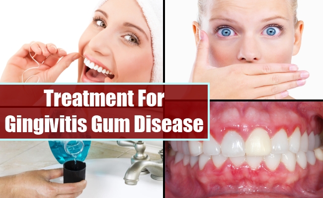 treatment for gingivitis